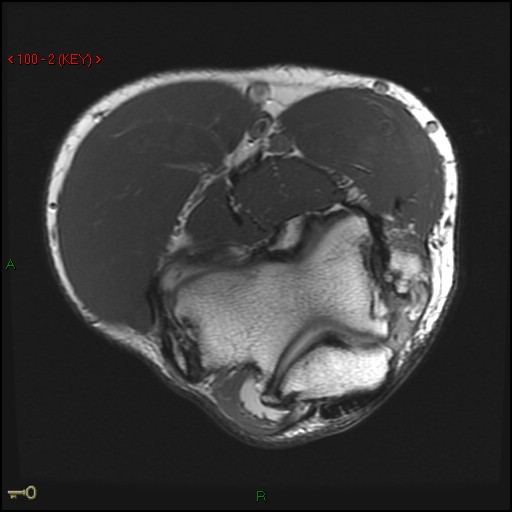 Figure 3 for case Ununited epicondylar fractures